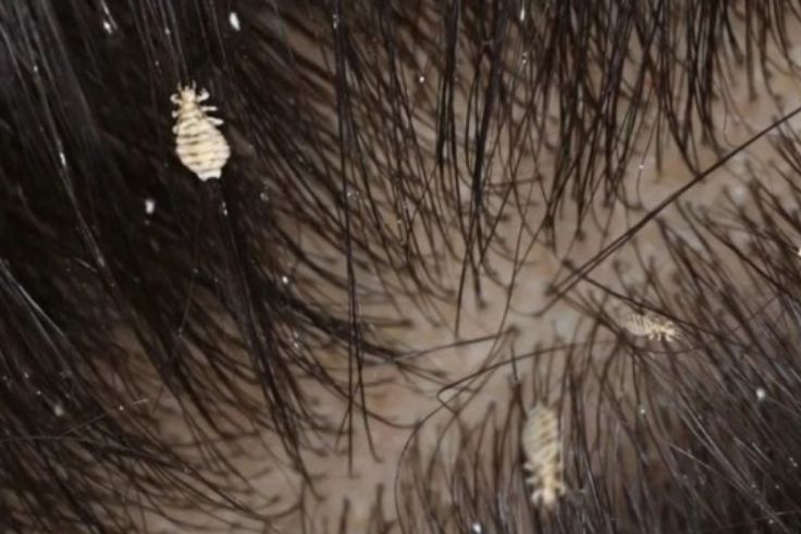 BALINEWS.ID - Kutu rambut, serangga kecil yang mengganggu, dapat diatasi dengan beberapa metode praktis dan efektif. Mulai dari perawatan sederhana hingga peng…