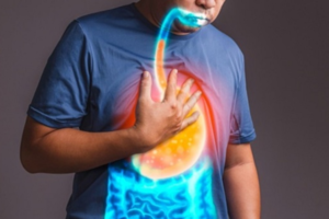 Ilustrasi asam lambung naik.