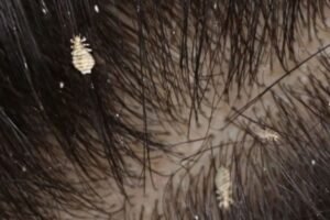 Cara cepat basmi kutu di rambut yang sebabkan gatal.